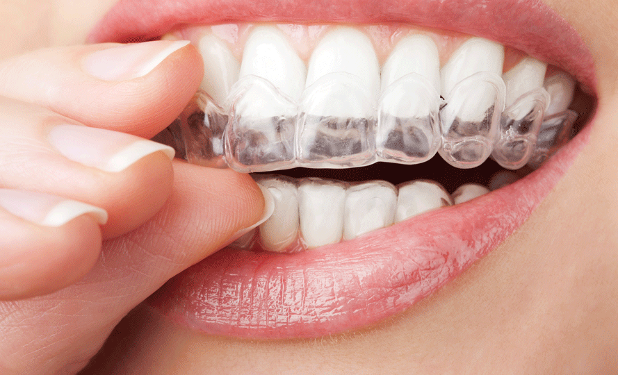 Как правильно отбеливать зубы