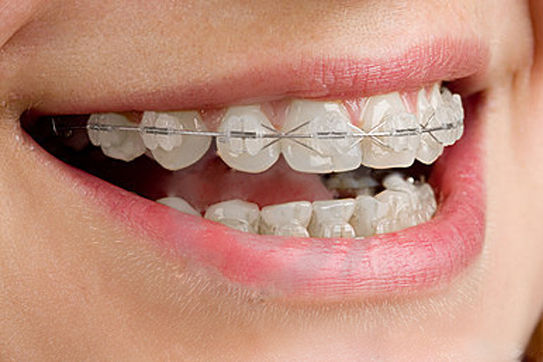 Почему надо корректировать форму зубов