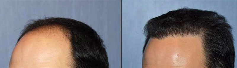 Аутотрансплантация волос