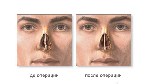 Коррекция перегородки носа