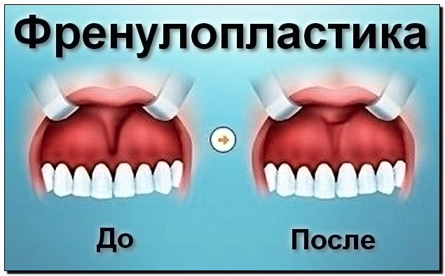 Пластика уздечки языка и верхней губы