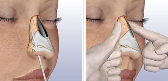 Удаление горбинки спинки носа